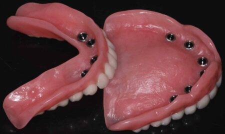 Snap-In Dentures