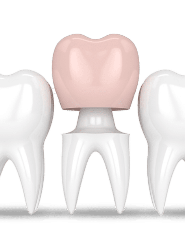 3 types of Crowns, you should know! Sabka Dentist Top Dental Clinic