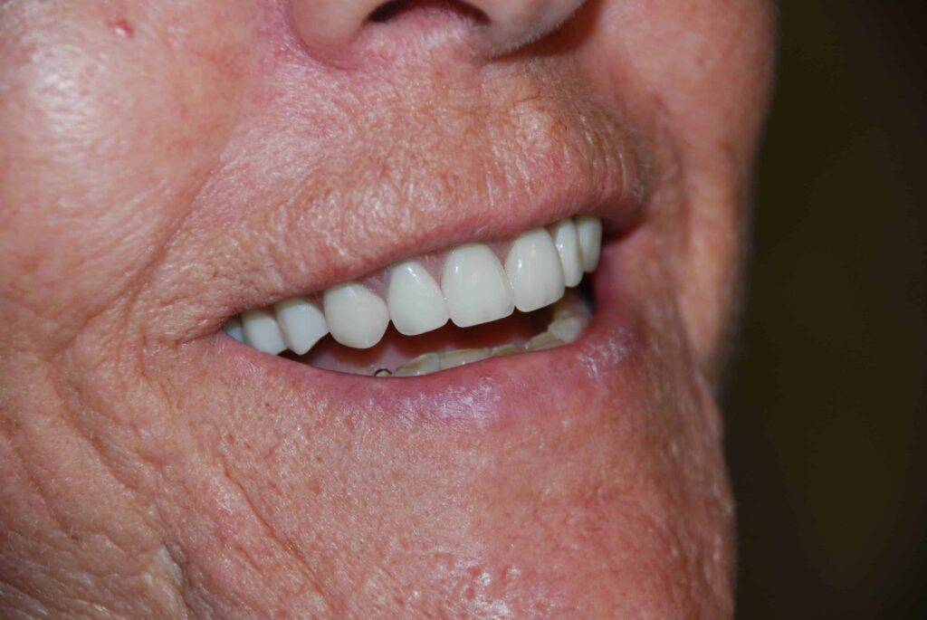 Overdentures Treatment