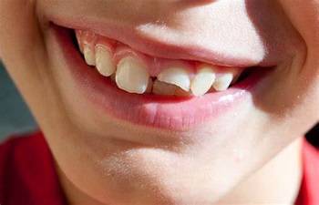broken teeth