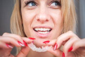 clear aligners