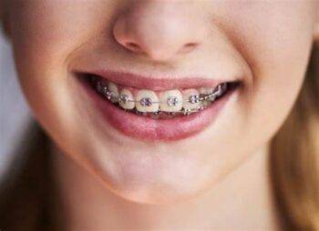 traditinal braces
