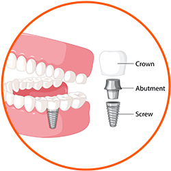 Dental-Implants-Step-by-Step-Procedure