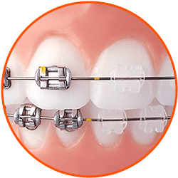 Self-Ligating-Options