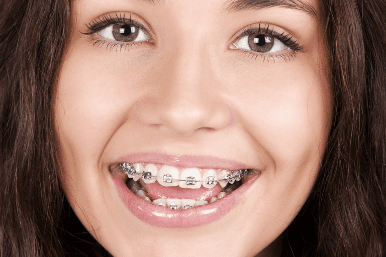 Why Self Ligating Braces