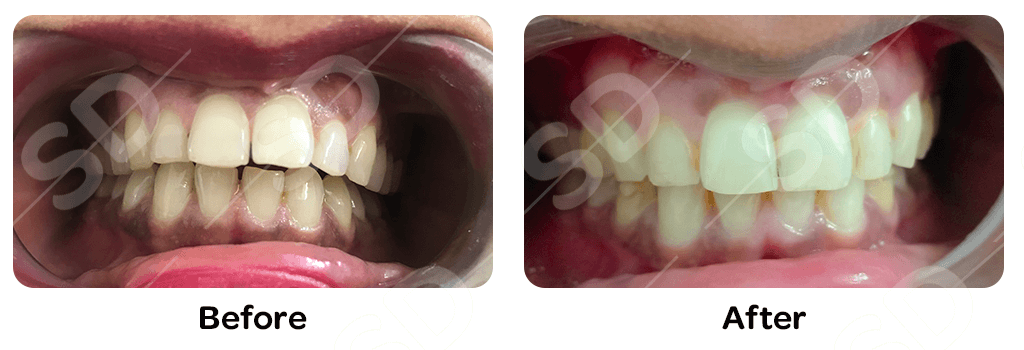 braces-before-after-02