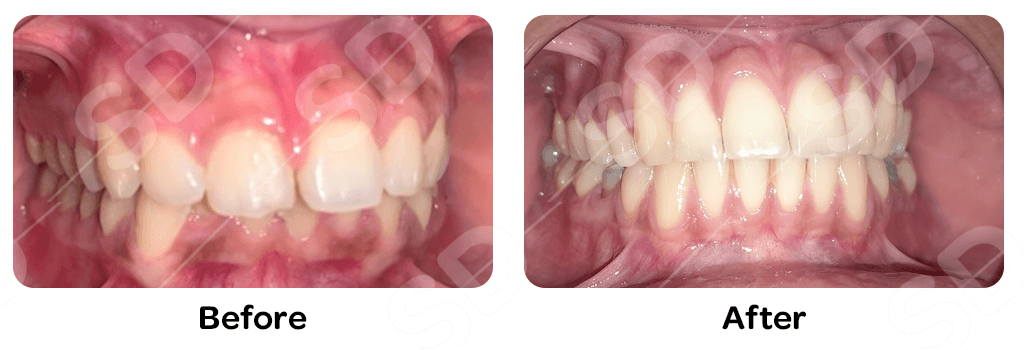 braces-before-after-03