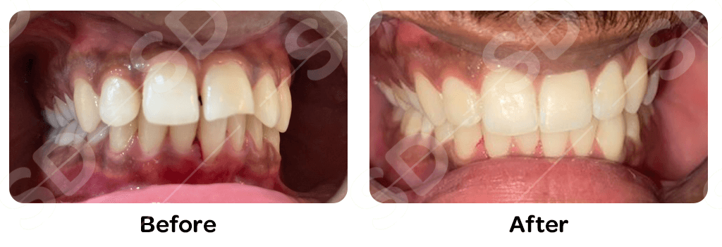 braces-before-after-04