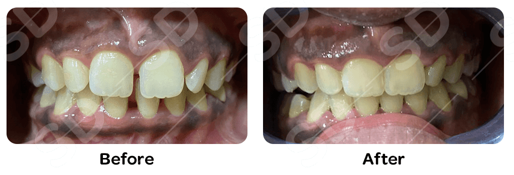 braces-before-after-05