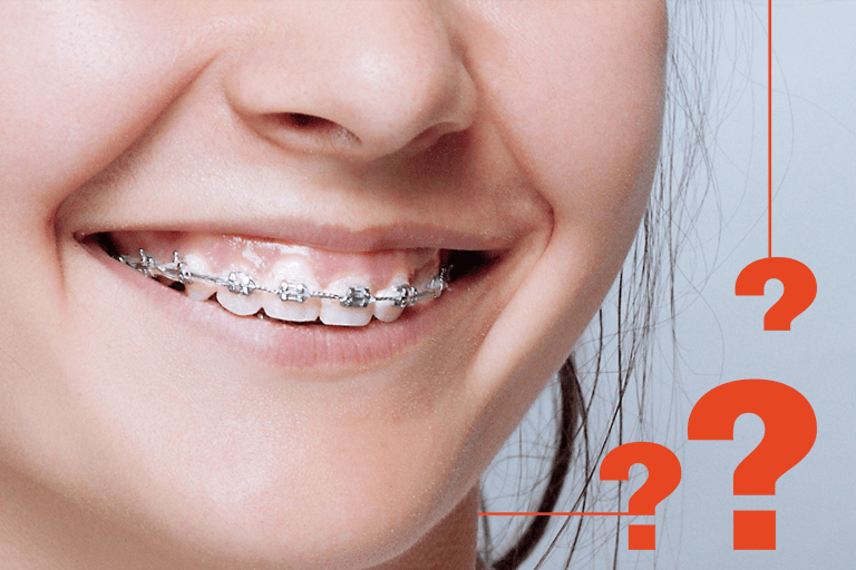 questions-about-braces-treatment