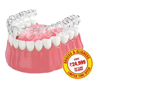 clear-aligners-at-sabkadentist