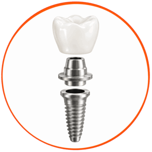 Dental-Implants-Biocompatible-Materials