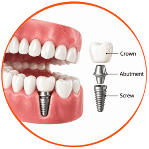 Dental-Implants-Step-by-Step-Procedure