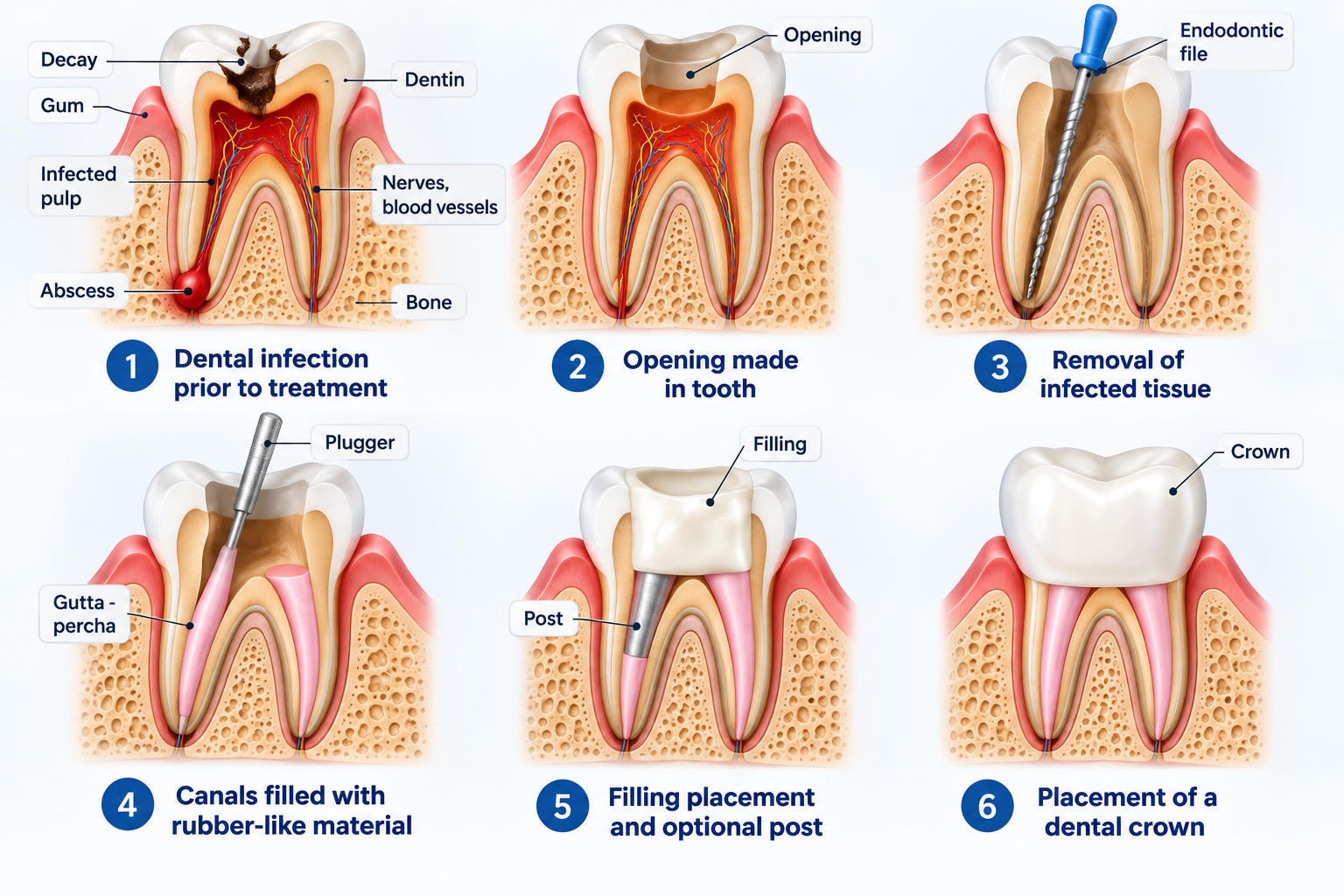 Root canal treatment procedure