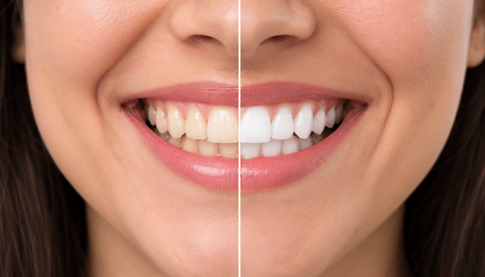 Teeth Whitening