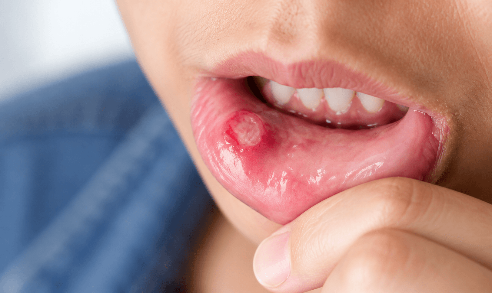stress and oral health mouth ulcer