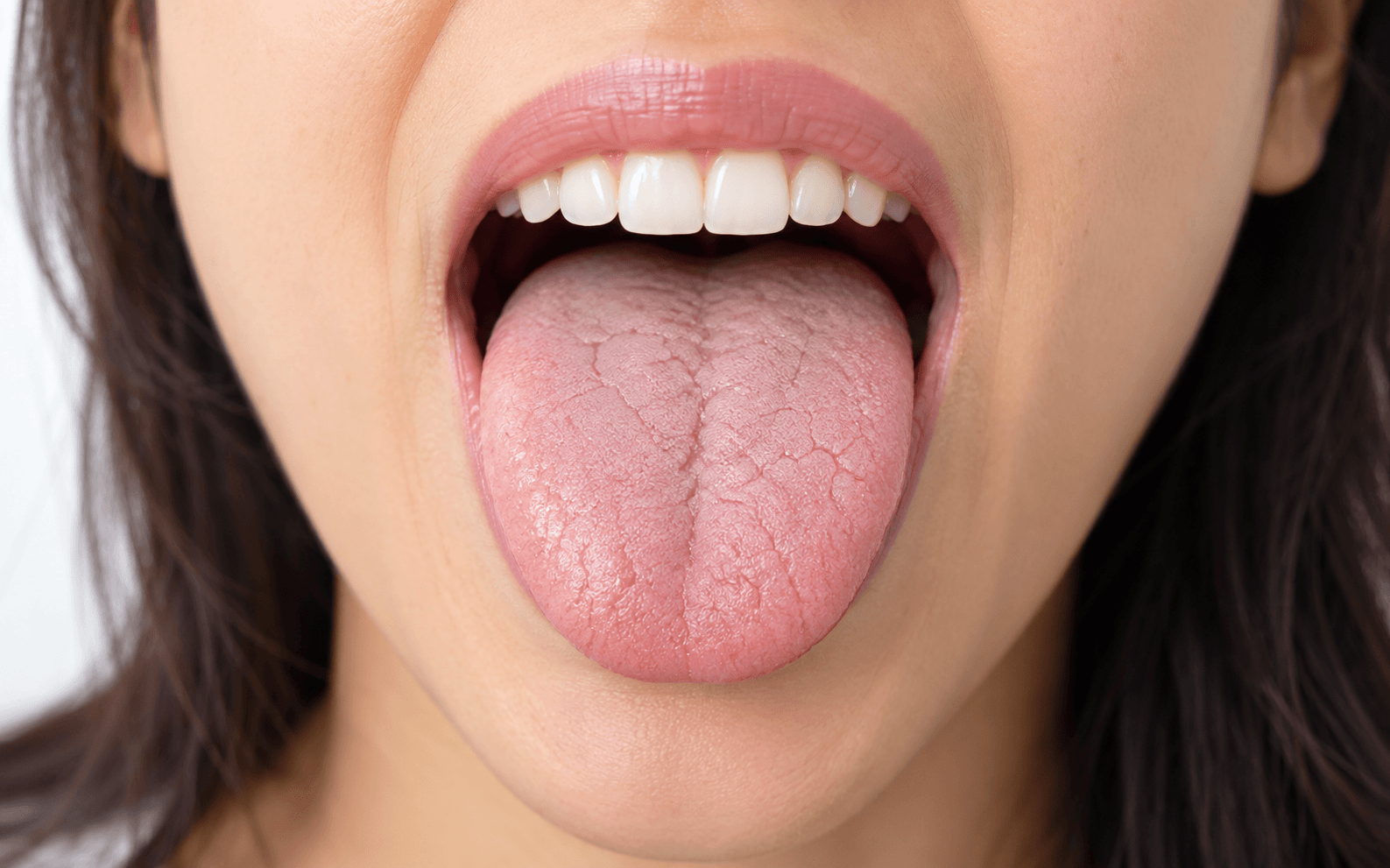 stress causes dry mouth