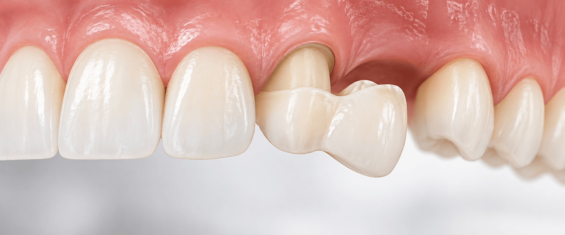 types-dental-bridges-cantilever
