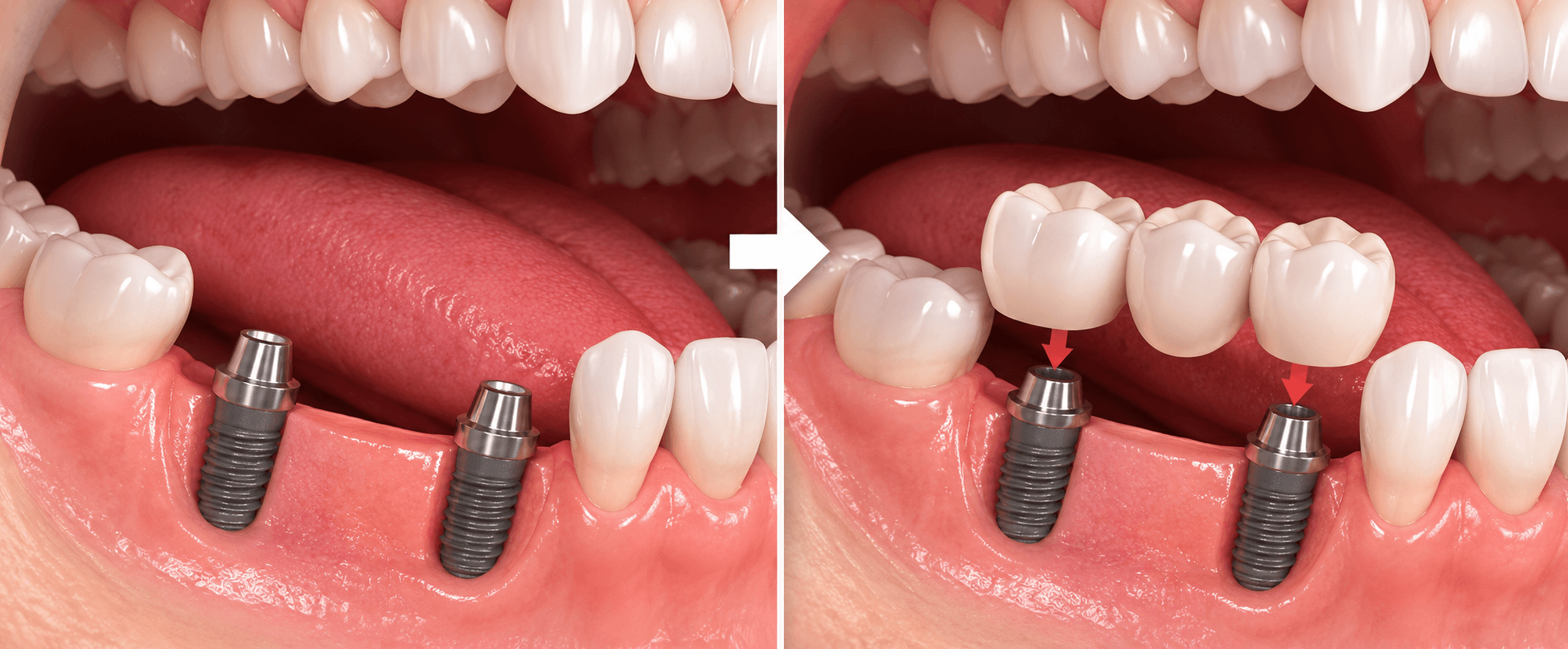 types-dental-bridges-implant-supported
