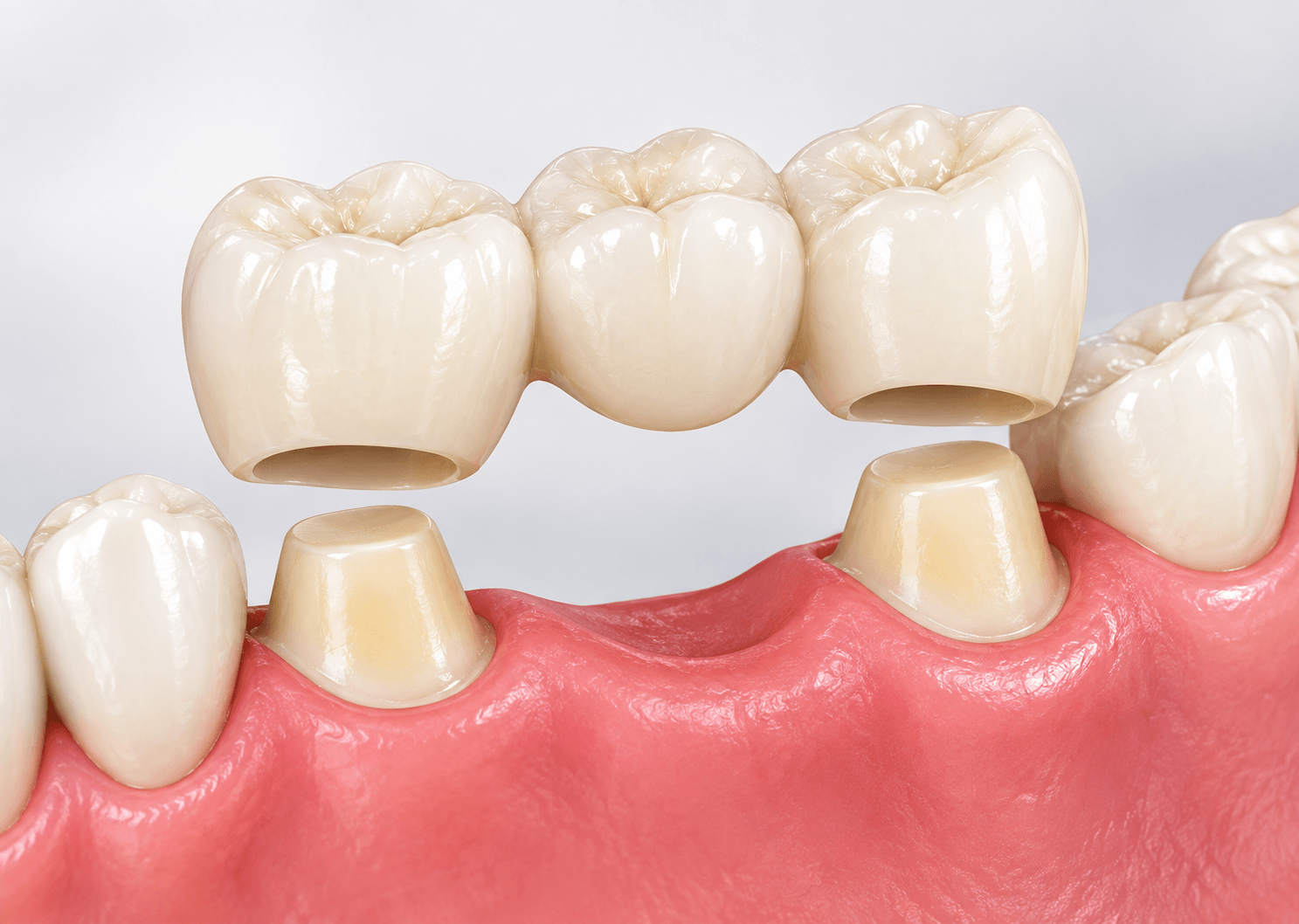 types-dental-bridges