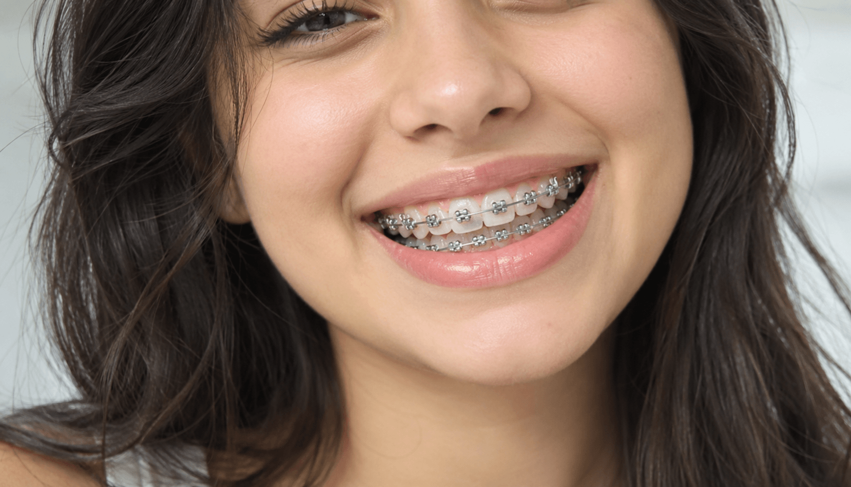 Metal Braces Treatment