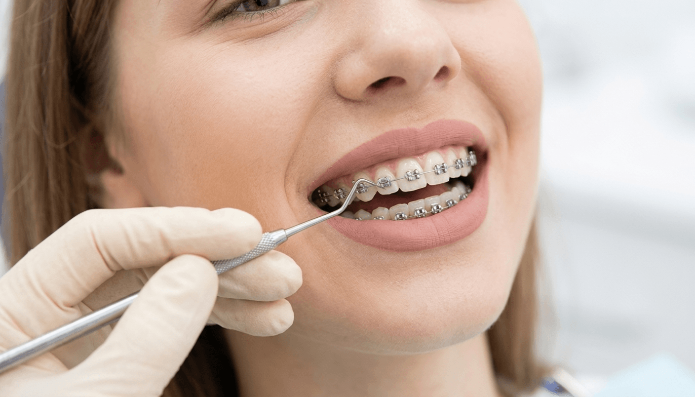 Signs for putting the braces Signs for putting the braces