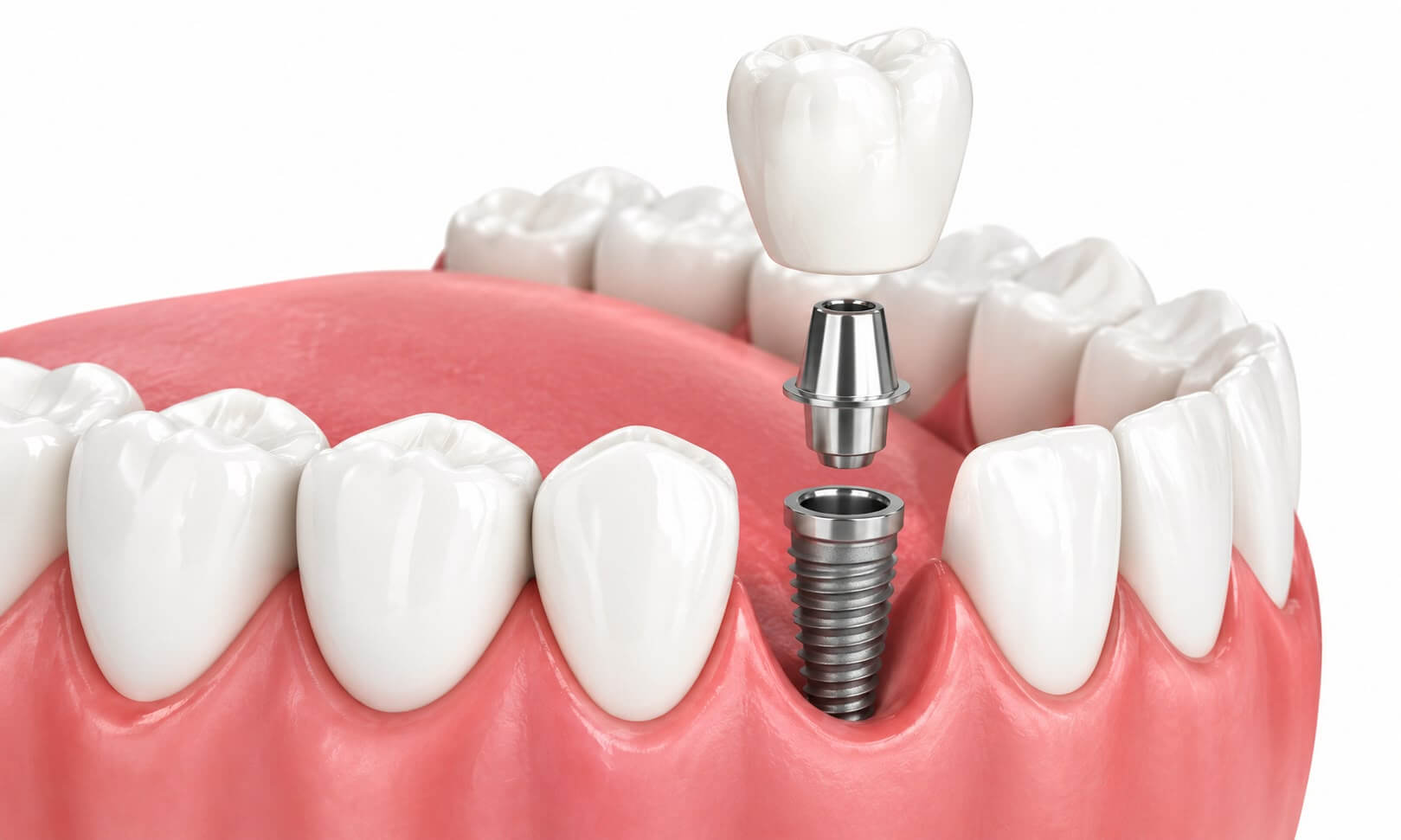 importance of replacing missing teeth 